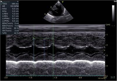 Neonatal hypertrophic cardiomyopathy with dyspnoea as the first symptom: a case report